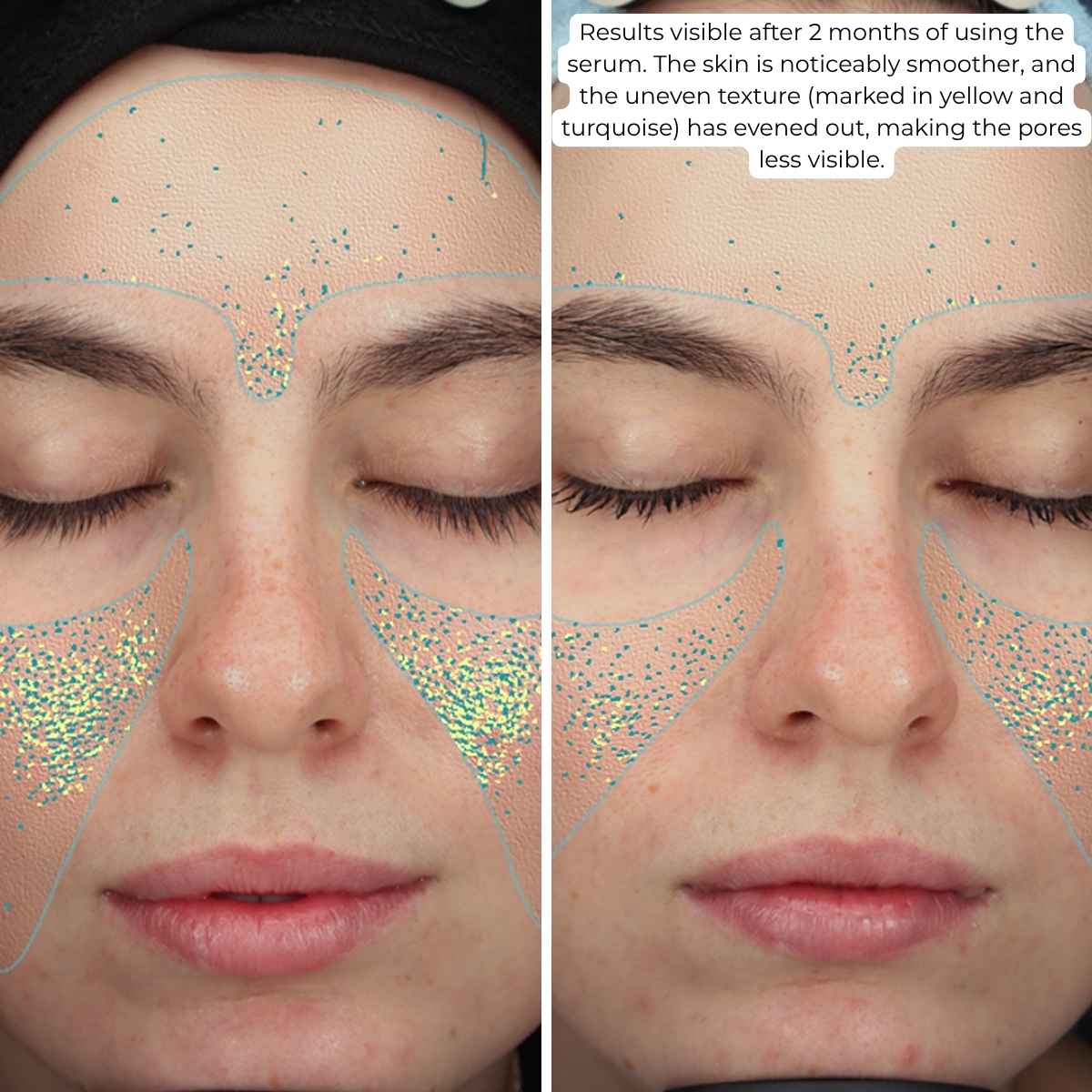 Natural Cosmetics ESTETICUS Stimulating Balancing serum, 0.3% adapalene acid ester, 5% collagen polypeptide complex, 0.25% PDRN 15ml